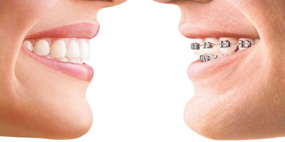 Invisalign Unveiled: A Comprehensive Guide to Clear Aligners at Amma Naana Dental Clinic