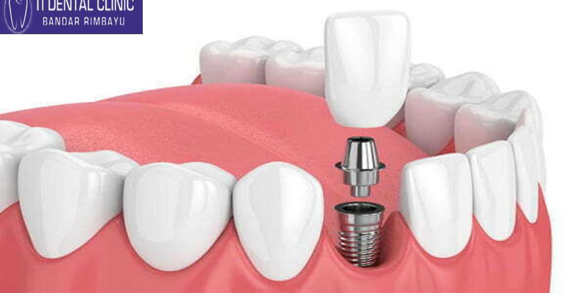 Smile Renewal: How Dental Implants Boost Self-Confidence